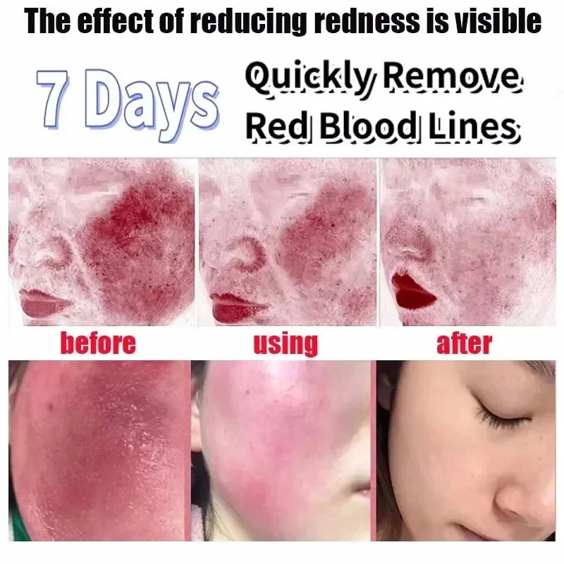 Facial Redness Repair Serum Improve Sensitive Skin Dryness Moisturizer Hydrating Sooth Lotion Removal Rosacea Korean Cosmetics